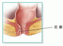 肛瘘如何治