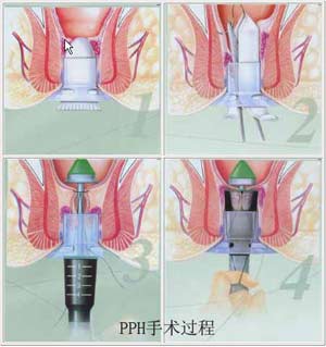 PPH��������