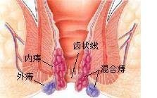 痔疮疼痛怎么办