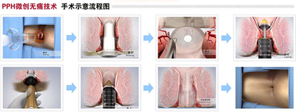 得了痔疮怎么治疗