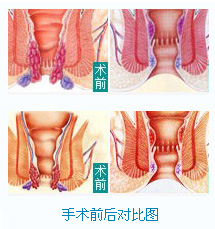 混合痔怎么治疗