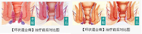 痔疮怎么治疗