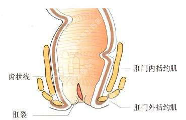 肛裂用什么治疗