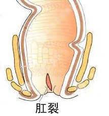 肛门裂口出血