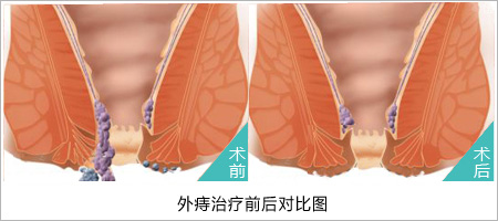 治疗外痔