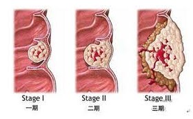 痔疮脱出怎么还原