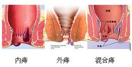 怎么确定是否得了痔疮