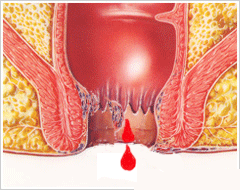 痔疮便血的症状