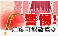 肛瘘的佳治疗方法