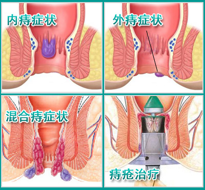 治疗痔疮